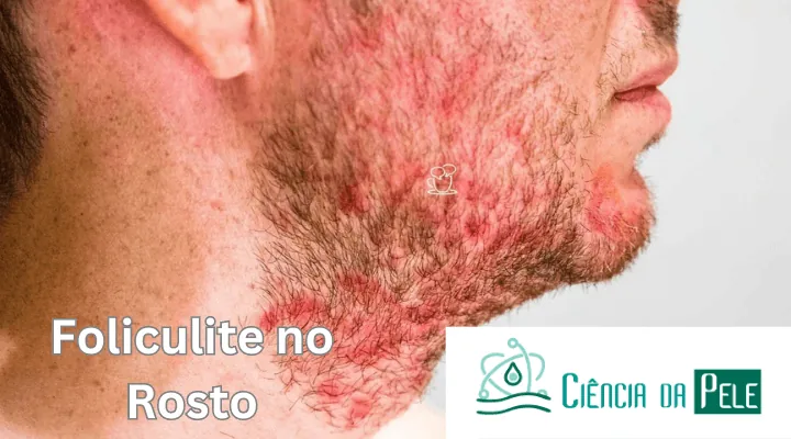 Foliculite no Rosto: Causas, Sintomas e Tratamentos