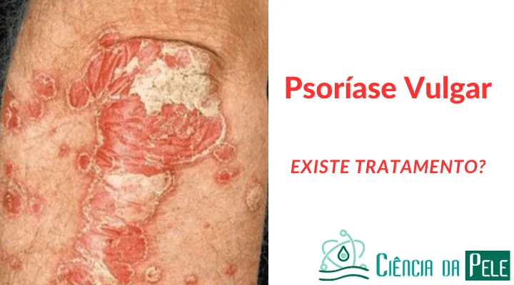 Psoríase Vulgar: Causas, Sintomas e Tratamentos Eficazes