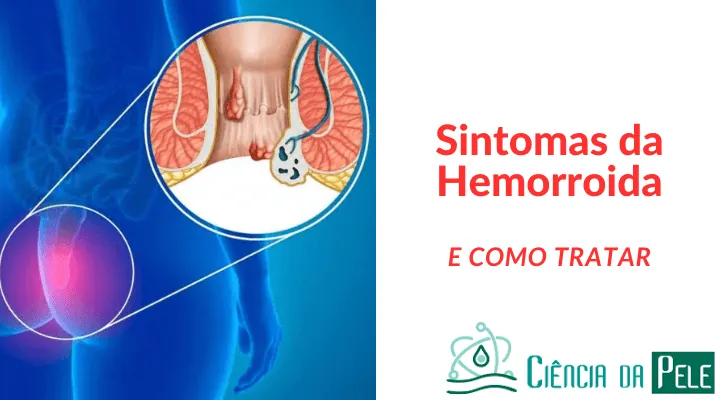 Sintomas da Hemorroida: Reconhecendo os Sinais e Como Tratar