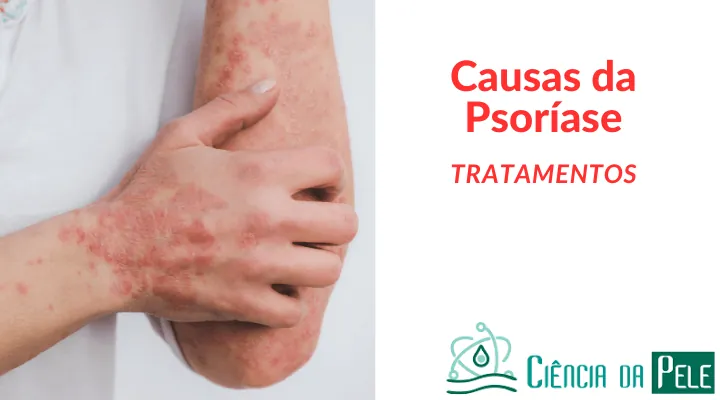 Causas da Psoríase: Entendendo os Fatores que Contribuem para a Doença
