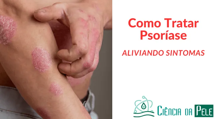 Como tratar psoríase: Dicas Eficazes para Aliviar