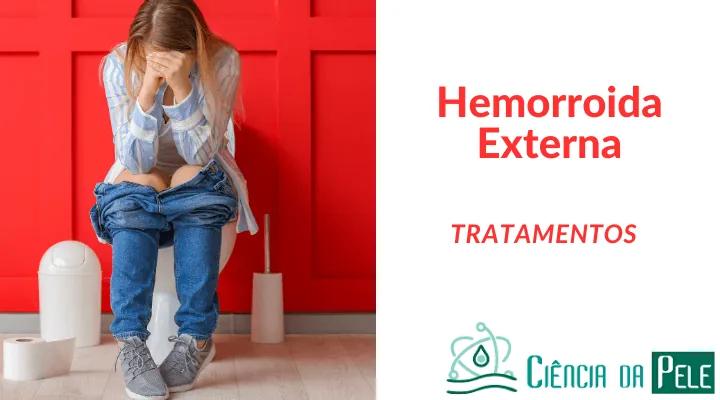 Hemorroida Externa: Causas, Sintomas e Tratamentos