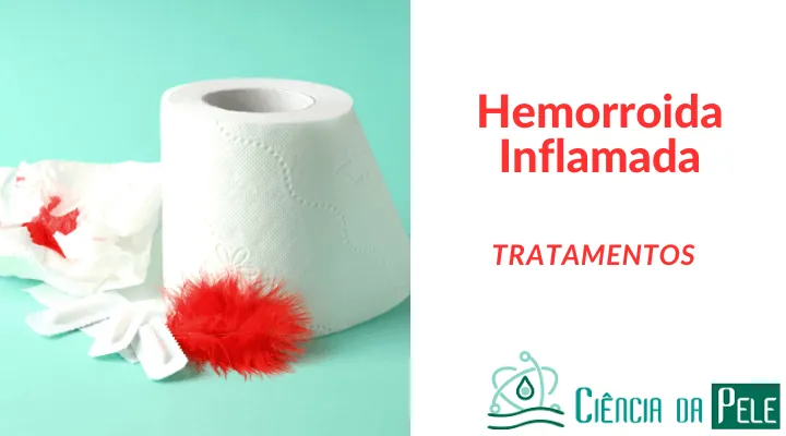 Hemorroida Inflamada: Causas, Tratamentos e Recomendações