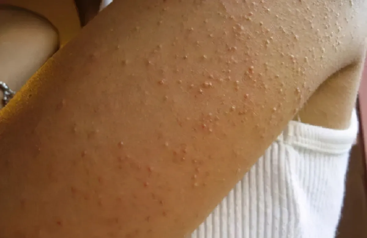 Pele de galinha: apelido da queratose pilar