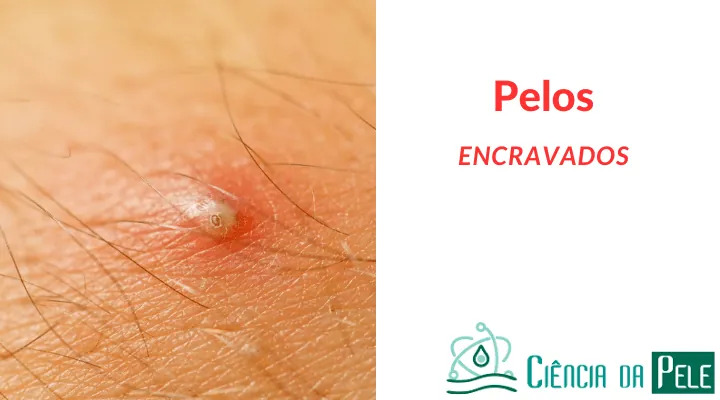 Pelos Encravados: Causas, Prevenção e Tratamentos Eficazes