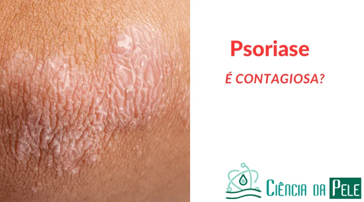 Psoríase é contagiosa? Mitos e verdades sobre a doença