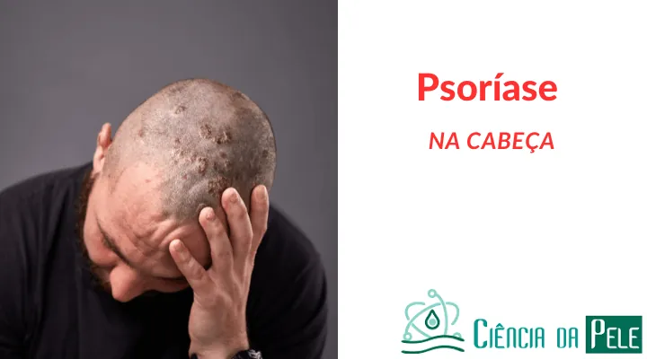 Psoríase na Cabeça: Sintomas, Causas e Tratamentos
