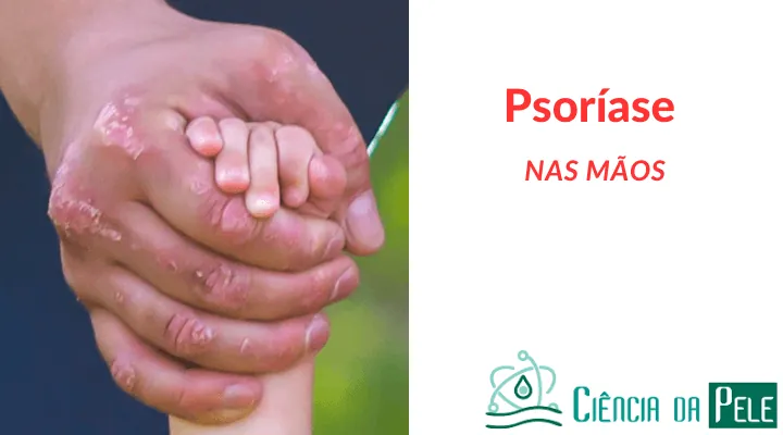 Psoríase nas mãos: Condição inflamatória crônica