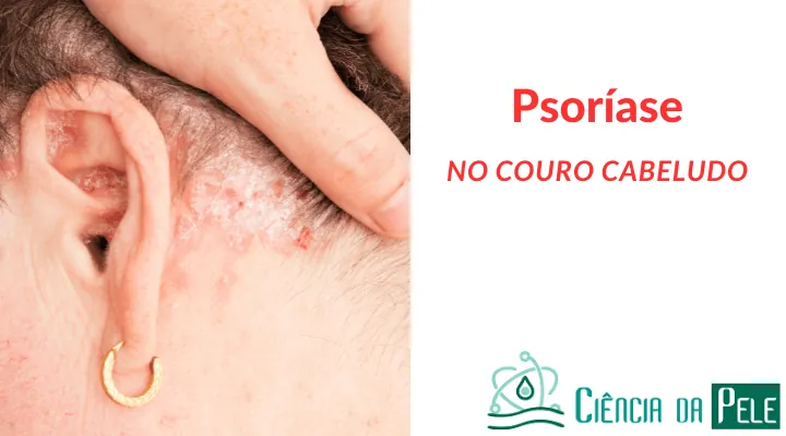 Psoríase no Couro Cabeludo: Causas, Sintomas e Tratamentos