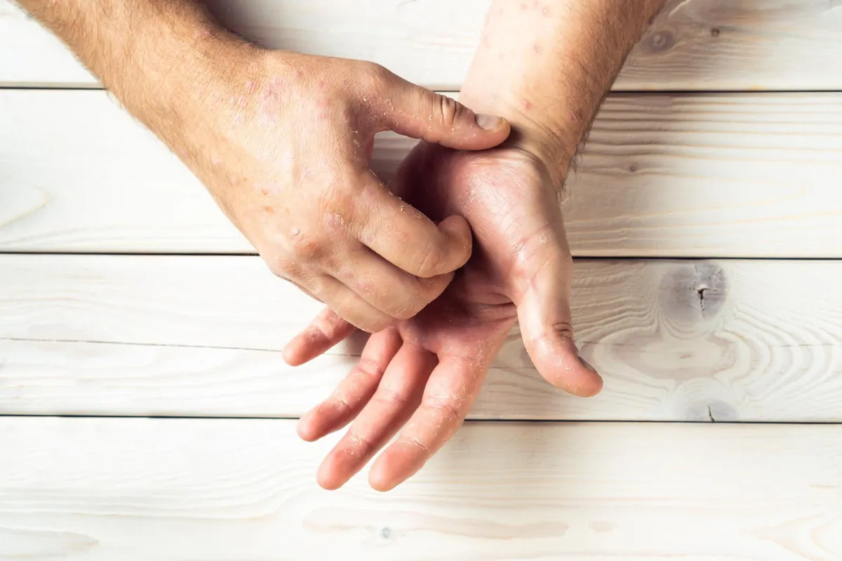 Melhor tratamento para psoríase palmo plantar
