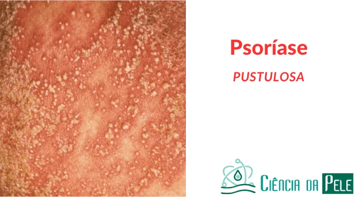 Psoríase Pustulosa: Sintomas e Tratamentos