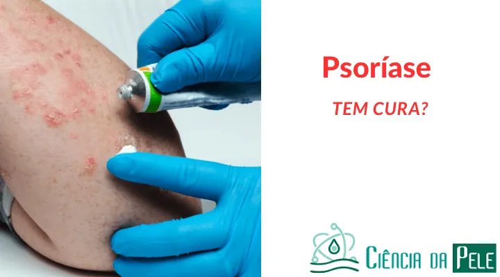 Psoríase tem cura? Entenda possíveis tratamentos
