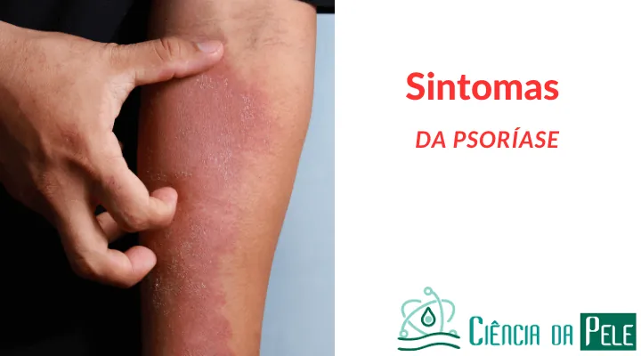 Sintomas da psoríase: 3 Características