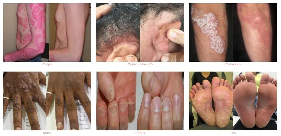 tratamento para psoriase antes e depois