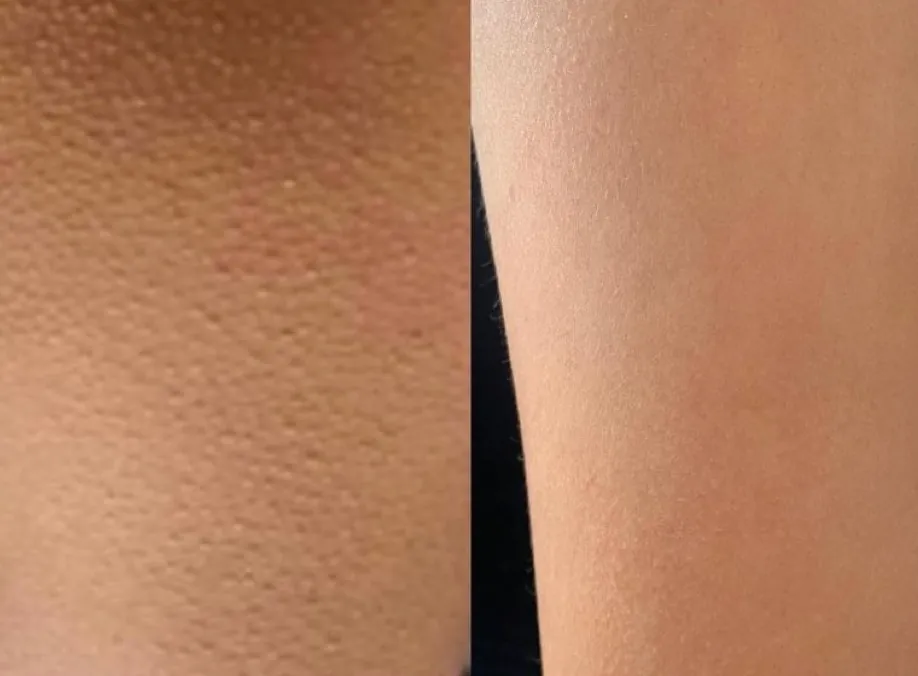 Tratamento para queratose pilar